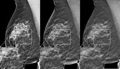 Mediolateral oblique images in 61-year-old woman with 12-mm invasive lobular carcinoma in the right breast. Left: FFDM image; middle: current synthesized 2D image; right: DBT image. The region of interest is magnified for each image. Reader scores for the study were 1 for FFDM, 3 for FFDM plus DBT, and 4 for synthesized 2D images plus DBT. This case was from study period 2.