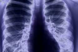 2014 06 13 12 23 24 49 Luminous Chest X Ray 200