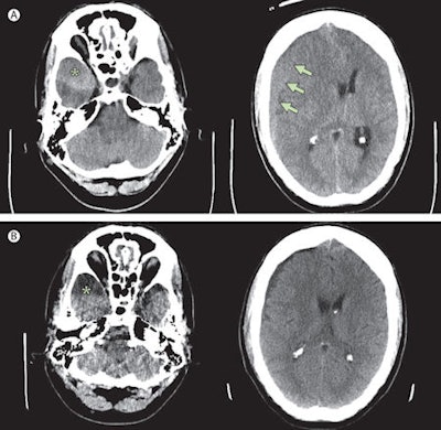 A: Preoperative CT scan shows chronic subdural hematoma (maximum width 20 mm, arrows) with midline shift and a clot (asterisk) at the tip of the right temporal lobe. B: Postoperative scan shows resolution of the subdural hematoma and an arachnoid cyst (asterisk) at the tip of the temporal lobe. The scans were performed without contrast using a system from GE Healthcare. Copyright © Institute of Diagnostic and Interventional Neuroradiology, Hannover Medical School.