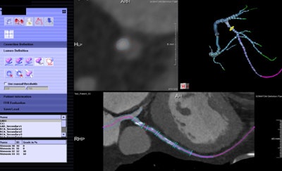 Noncommercial work-in-progress FFR-CT application from Siemens Healthcare estimates blood flow in vessels.