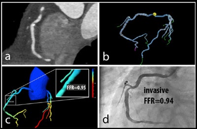 Patient with right coronary artery stenosis visualized on CCTA (a). Investigative FFR-CT application measures stenosis severity at 0.95 (c), confirmed at 0.94 on invasive angiography (d). All images courtesy of Dr. Koen Nieman.