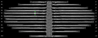 Curved planar reformatted or 'unfolded' rib view image processed with the syngo.CT Bone Reading application. Image courtesy of Siemens Healthcare.