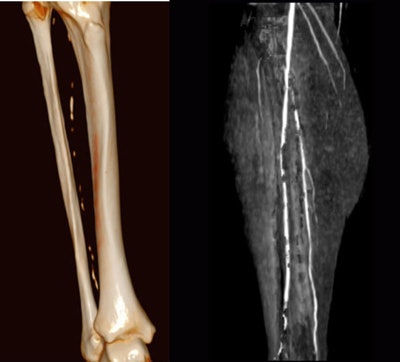 Patient with lower-limb calcifications. Dynamic bone-subtracted dynamic CTA (below) separates the contrast from the calcifications.