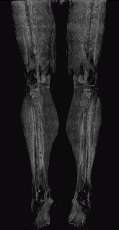 lower limb calcifications