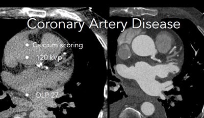 Calcium scoring exam was acquired at 120 kVp.