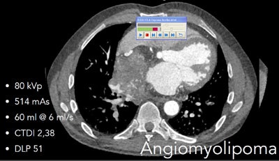 Angiomyolipoma contains areas of calcium and fat, imagined at DSCT in high-pitch scan mode, in image acquired at 80 kVp. Dose was 0.61 mSv. Coronary arteries and tumor extent are clearly visible, as are areas of fat and calcium within the tumor, which caused the patient no disability for a decade.