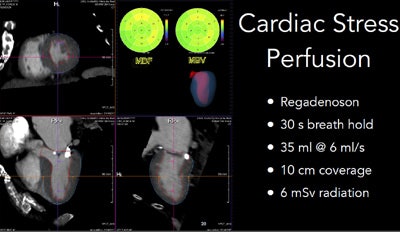 Cardiac stress perfusion scan.