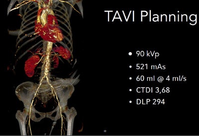 The protocol causes the scanner to arrive at the heart during the systolic phase to save both contrast and dose, and the results of TAVI planning with third-generation DSCT are excellent, he explained.