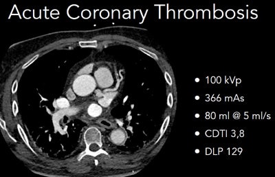 Patient with acute coronary thrombosis underwent a triple rule-out scan acquired at 100 kVp and 366 mAs.