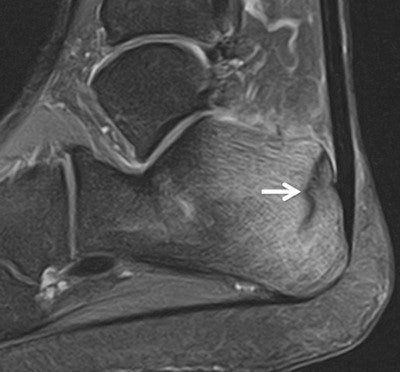Male long-distance runner, 22, with a two-week history of heel pain. Sagittal T2-weighted fat-saturated image (Toshiba, Elan 1.5-tesla) shows linear hypointensity (arrow) in the posterior calcaneus and diffuse high signal intensity in the adjacent marrow in keeping with a recent incomplete fatigue stress fracture with surrounding marrow edema. All images courtesy of Dr. David Ritchie.