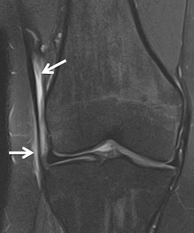 Female hockey player, 18, with anterolateral knee pain for two days. Coronal T2-weighted fat-saturated image (Toshiba, Elan 1.5-tesla) shows high-signal intensity around the iliotibial band on the lateral aspect of the knee in keeping with iliotibial band syndrome. This is thought to be caused by friction of the band as it repeatedly crosses the lateral condyle during flexion and extension.