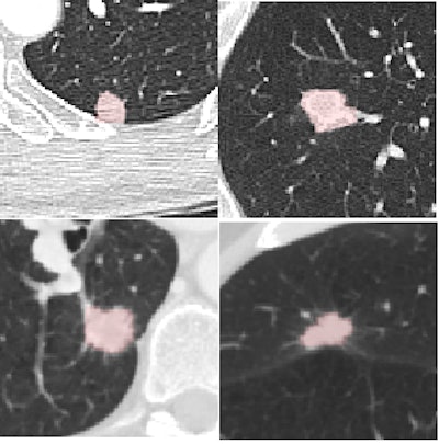 Four reference nodules from the LIDC dataset that were automatically detected and segmented by the CAD system. Color overlay shows the automated segmentation result from the system. Images courtesy of Dr. Matthew Brown.