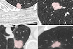 2014 08 08 10 48 52 299 Brown lungcad 20140808175146