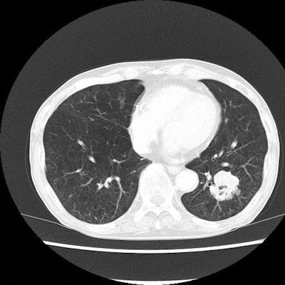 A pair of lung CT images of a patient with emphysema and lung cancer. Above, the image obtained with filtered back projection looks noisy. Below, the image produced with iterative reconstruction has improved noise profile while preserving the anatomical detail, which contributed to radiation dose reduction. Images courtesy of Dr. Takeshi Kubo.