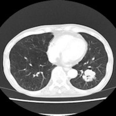 2014 08 11 15 04 51 8 2014 08 12 Ct Lung2 200