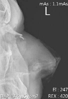 Male, 40, sustained nasal bone fracture during a league match. He was not wearing a protective helmet.