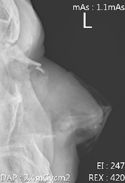 Male, 40, sustained nasal bone fracture during a league match. He was not wearing a protective helmet.