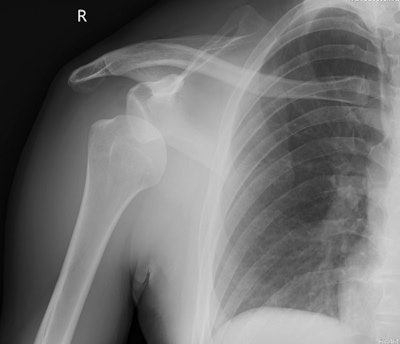 Male, 33, sustained anterior inferior dislocation of the humeral head during inter-club match.