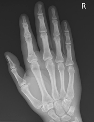 Male, 20, sustained fracture to base of the proximal phalanx of the index finger during training.