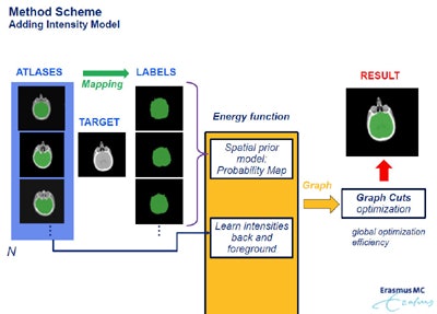 Atlas-based segmentation was improved by the addition of CT intensity measurements, above, in the cerebellum.