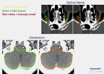 Segmentation of the optical nerve and cerebellum are more accurate with the addition of intensity information (p < 0.05).