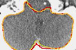 2014 08 22 13 49 05 816 2014 08 25 Nissein Autosegmentation Atlasplusintensity 20140822205710