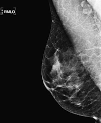 Normal mammography image of 54-year-old woman