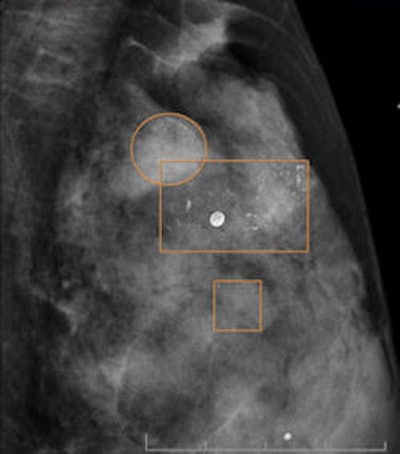 A 58-year-old woman with in-situ ductal carcinoma 29 mm in size. Immunohistochemical staining demonstrated focus of microinfiltration (1 mm). In digital mammography, some pleomorphic calcifications correctly depicted by CAD can be seen.