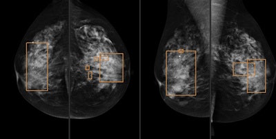 A 57-year-old woman with invasive ductal carcinoma 18 mm in size. CAD rectangles indicate calcifications. In the upper outer quadrant of the left breast, an architectural distortion not detected by CAD can be seen.