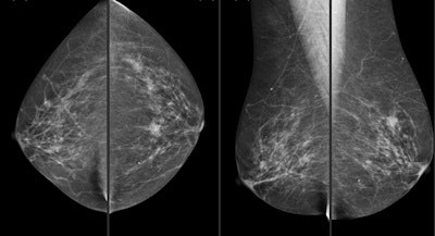 A 62-year-old woman with invasive ductal carcinoma 11 mm in size. Above: Plain digital mammography with a focal asymmetry in left breast. Below: CAD correctly detected the lesion. All images courtesy of Dr. Xavier BargallĂł.