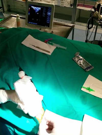 Wireless ultrasound probe used to visualize vein in the right femoral artery. All images courtesy of Dr. Daniel Rodriguez Muñoz.