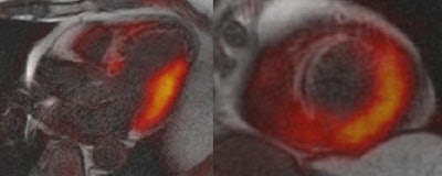 Fusion image of LGE MRI and PET in a four-chamber long-axis (left panel) view and a short-axis view (right panel) in a 60-year-old man with ST segment elevation myocardial infarction (STEMI) because of a proximal occlusion of the left anterior descending (LAD) artery. MRI revealed a transmural infarction within nearly the entire septum and the apex of the left ventricle (late gadolinium enhancement with an area of no-reflow), whereas a corresponding area of reduced tracer uptake can be seen in the perfusion territory of the LAD. The fusion images also demonstrate a significantly larger defect of FDG uptake (reduced viability) than the extent of the late gadolinium enhancement image. All images courtesy of Dr. Ercan Tezgah.
