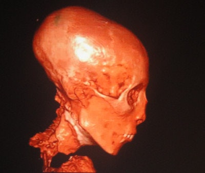 Top: Color volume-rendered CT scan of King Tutankhamen shows his elongated skull with an overbite. Bottom: CT images of his skull. All images courtesy of Dr. Ashraf Selim.