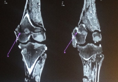 Coronal ultrathick multiplanar reconstruction (MPR) CT image of the lower part of the femur of King Tutankhamen. Note the fracture of the metaphyseal region with cracks traversing the resin used in the mummification process. The arrow points to the fracture with a thin layer of dense embalming material covering the fractured edges.