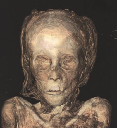 CT scan showing the remarkable preservation of the facial features. The eyelids, lips, and nose are preserved, and the hair is clearly seen. All colored illustrations from Taylor JH, Antoine D. Ancient Lives New Discoveries: Eight Mummies, Eight Stories. London: British Museum Press; 2014.