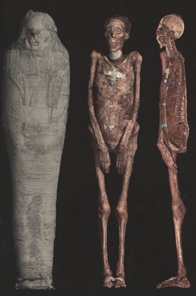 Modern CT scan showing the virtual removal of the wrappings illustrating the mummified remains. The sectioned image on the right shows the internal structures.