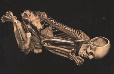 Sectioned image of a naturally mummified body.