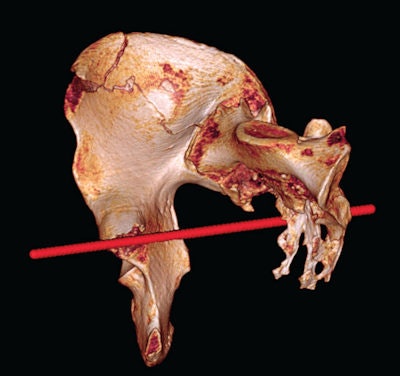 Image of right hemi-pelvis and sacrum reconstructed from postmortem CT scan with Osirix software. Red line shows estimated direction of sharp-force trauma.