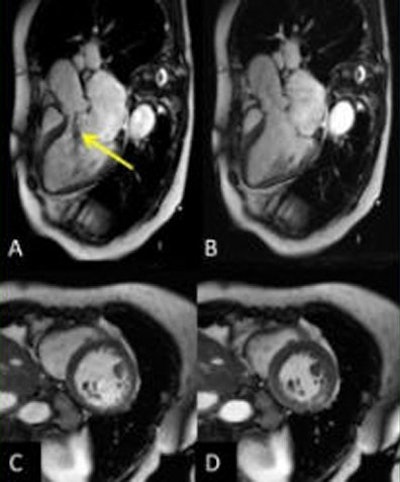 Above, compressed sensing acquisition in a 79-year-old with LV systolic dysfunction (LVEF 41%) and severe aortic regurgitation (regurgitation fraction 36%, arrow) performed before an aortic valve replacement. Images A and B represent a three-chamber view in diastole. C and D represent a mid short-axis view in diastole/systole. Neither flow-related artifacts nor fold-over artifacts can be seen. All images courtesy of Dr. Juerg Schwitter.