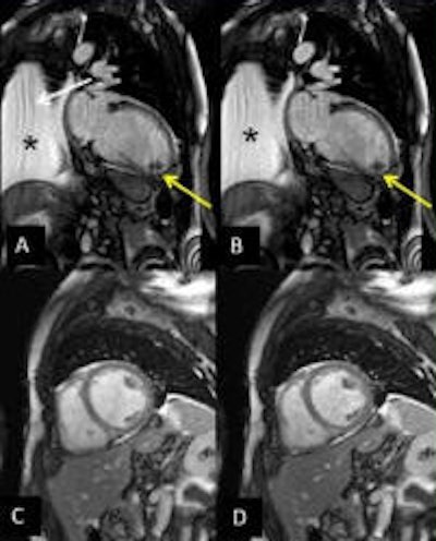 Compressed sensing acquisition in a 58-year-old patient with dilated cardiomyopathy, LVEF of 8%, an apical thrombus (yellow arrow), and pleural effusion (asterisk). A mild fold-over artifact can be seen in the two-chamber view (white arrow), but quality is sufficient to detect the apical thrombus. A/B represent a two-chamber view in diastole/systole. C/D represent a mid short-axis view in diastole/systole.