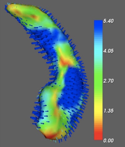 Hippocampal volume analysis. Image courtesy of MedimSight and FMRIB Analysis Group.