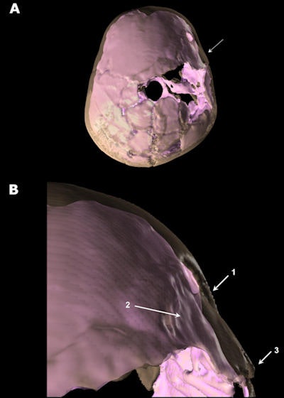 Above, superior view of Qafzeh 11 3D reconstructed skull showing the depressed fracture on the frontal right side. The skull vault appears in transparency and the virtual endocranial cast in pink. A: General view. B: Close-up view of the trauma area. 1: anterior part of the frontal bone depressed fracture penetrating the endocranial volume. 2: irregular shape of virtual endocranial surface indicating brain damage. 3: diastasis of the right coronal suture. Images republished courtesy of PLOS One.