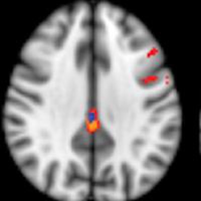 2014 10 08 12 21 42 249 Asl Mri Cortex Larger 400 20141008192208