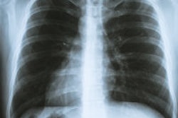 2014 10 10 11 48 04 966 Chest X Ray 200