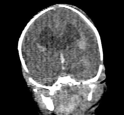 Coronal image of the brain shows dilated cerebral ventricles.