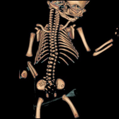 3D skeletal reconstruction shows a hemivertebra and extra rib.