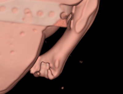 Surface-rendered CT image of a 20-week-fetal hand demonstrates the typical overlapping digits of trisomy 18.