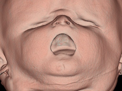 Surface-rendered CT image of a 38-week-fetus shows the intact palate. All images courtesy of Dr. Sarah Constantine.