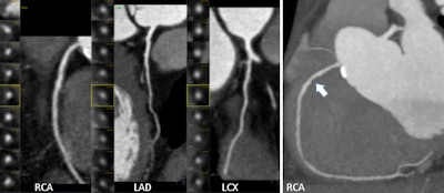 CCTA finds significant coronary artery disease in symptomatic 64-year-old man. Patient has hyperlipidemia and a family history of coronary disease; is an ex-smoker. Patient also underwent a nonspecific pathologic stress test. All images courtesy of Dr. Fabian Plank.