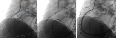 Two years (680 days) later, patient had ACS (STEMI), right coronary artery (RCA) stenosis of 100%, CKmax 1,416 ng/dL, TNTmax 3,315 ng/L.